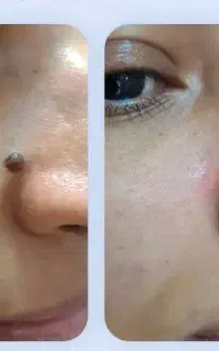 خالبرداری حرفه ای بدون درد و خونریزی