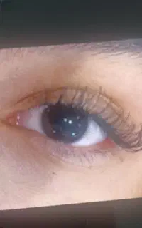 کاشت مژه