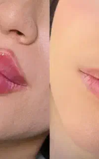 تخفیف 50 درصدی تزریق ژل و بوتاکس