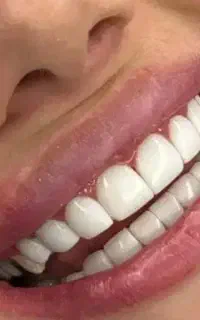 کامپوزیت واحدی۹۰۰/دندان مصنوعی/پرکردن