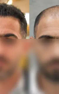 کاشت مو با ۳ میلیون پیش پرداخت