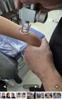 لیزر CO2 برطرف کردن اسکار (دکتر علی بابایی)