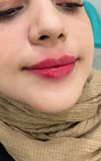 فیلر و بوتاکس نوروزی کلینیک بهتا