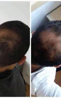 تو باورت نمیشه ولی خیلی راحت موهات درمان میشه
