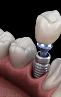 با ۱۷ میلیون صاحب ایمپلنت کره ایی شوید