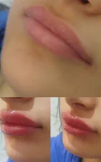 بوتاکس،انواع فیلر ومزوتراپی (وعمل های زیبایی زنان)