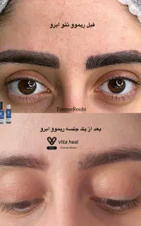 ریموو تخصصی تتوی صورت با هزینه استثنایی/فرصت محدود