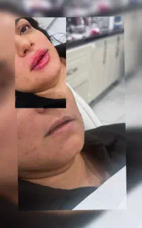 مدل برای تزریق ژل لب