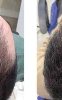 پی آرپی ،مزوتراپی،فیلر و بوتاکس