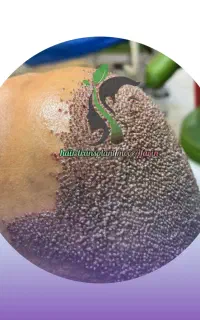 کاشت مو به روش میکرو گرافت