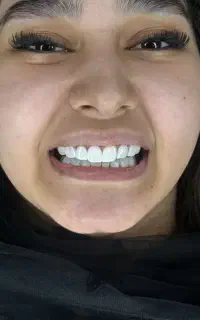 کامپوزیت باکیفیت طرح لمینت تخفیف ویژه