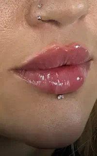 تزریق ژل و بوتاکس جشنواره