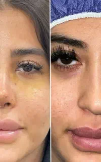 عمل بینی فقط ۶۰ میلیون/اقساطی/بهترین متخصص شیراز/