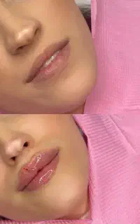 رفع خطوط به شکل طبیعی