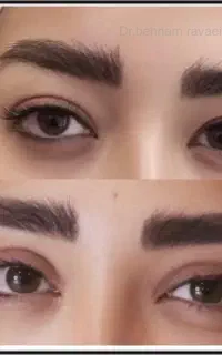 بلفاروپلاستی جراحی عمل پلک (بخیه لیزری)و کاشت مو