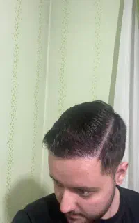 کاشت مو پرتراکم اقساطی