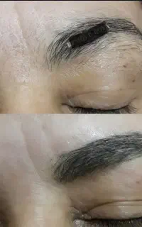 ریمو(پاک کردن)تتو صورت