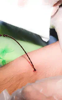 فصد پیشانی حجامت زالو درمانی