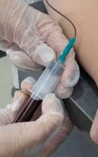 اگر کاشت مو انجام دادید وقت پی آر پی رسیده