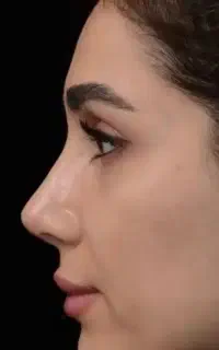 ۳ ماه تنفس در پرداخت اقساط جراحی بینی