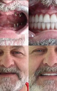 ایمپلنت کره ای 13.9 اقساط بدون بهره