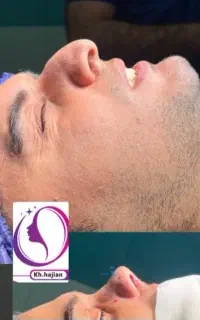 جراحی زیبایی بینی