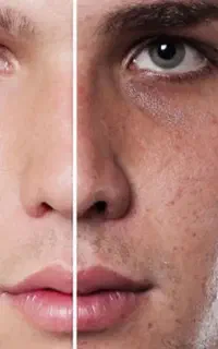 خداحافظی با جوش و چربی اضافه و سلام به پوست شفاف