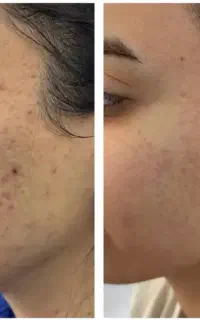 طرح تخفیف فیلر بادی ،ژل و بوتاکس