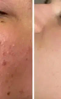 prp