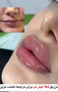 فیلر و بوتاکس و ژل لب
