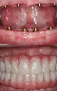 ایمپلنت در حد آلمانی فقط13500،اقساطی