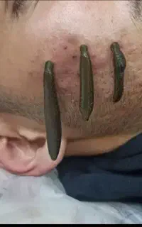فصد پیشانی در امیدیه