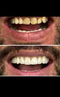 کامپوزیت اقساطی/دندانپزشکی