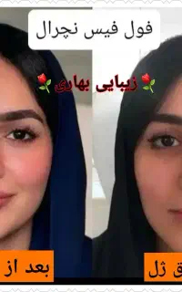 آف ویژه فول فیس/ژل لب روسی/چانه/گونه/بوتاکس زاویه