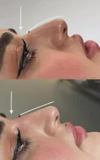 ساکشن بینی. لیفت بینی. کوچیک کردن بینی(کلینیک)