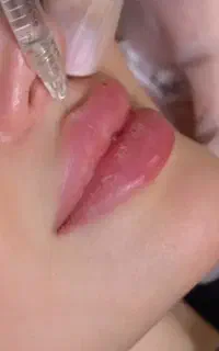 تزریق ژل ،بوتاکس ،مزو ،خالبرداری