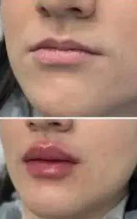 تزریق حرفه ای و قیمت مناسب با بهترین فیلر ها
