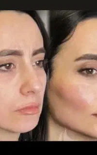 کلینیک تخصصی فرسیما/لیفت نخ/کانتورینگ/فیلر/بوتاکس
