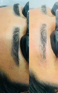بروز ترین لیزر رفع تتو و کربن تراپی
