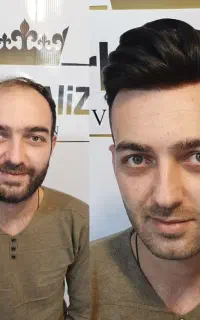 پروتز مو و چسب پروتز مو شیراز Aliza