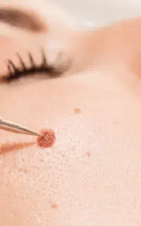برداشت خال و ضایعات پوستی