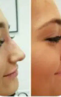 رفع نواقص بینی بدون عمل