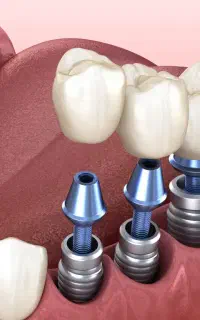 ساخت روکش ایمپلنت دندان و دندان مصنوعی
