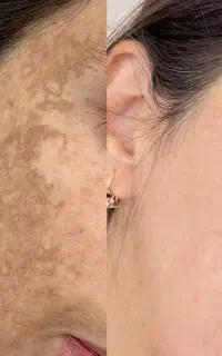 با لک و جوش هات خدافظی کن