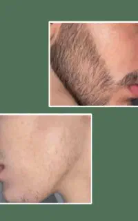 معجزه ریش