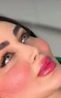 تزریق ژل و بوتاکس چربی و ساکشن چربی