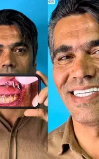 ایمپلنت دوازده ماهه