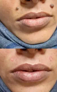 برداشتن خال،منگوله گوشتی مزوتراپی