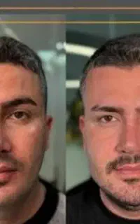 تپل شدن صورت ،کانتورینگ صورت بوتاکس رایگان