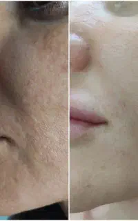 کرم ضدلک روشن کننده